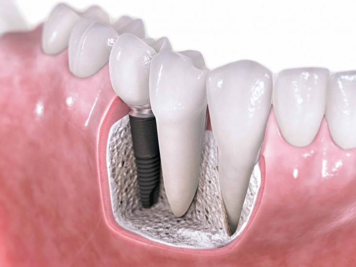 Dental Implants Billings MT